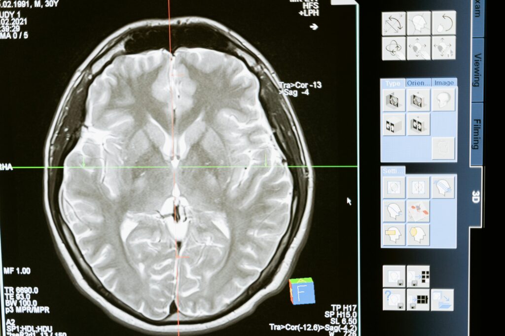 Brain MRI Cost in Pune